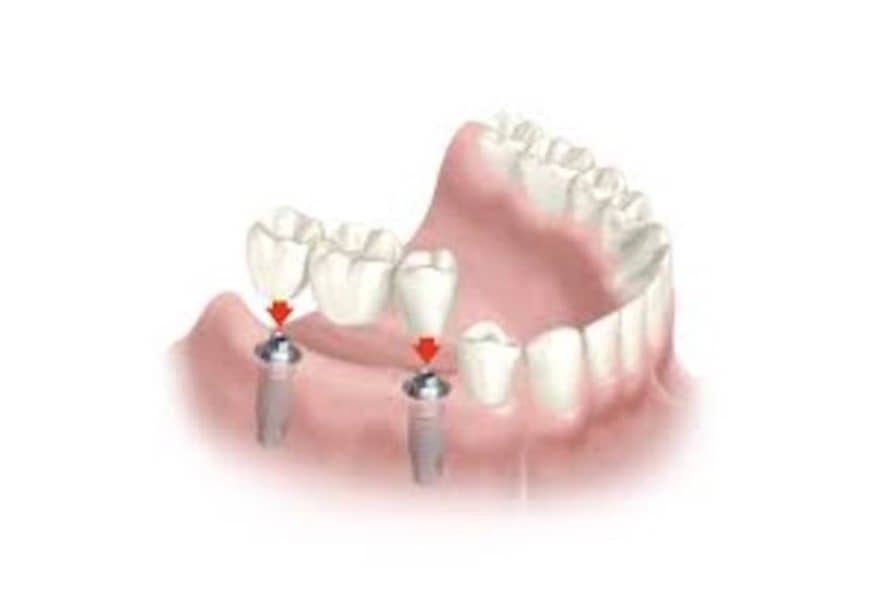 implantes-dentales-diagnosticos-tratamientos-de-vanguardia-clinica-ferreiro