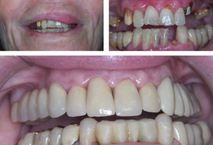 implantes-dentales