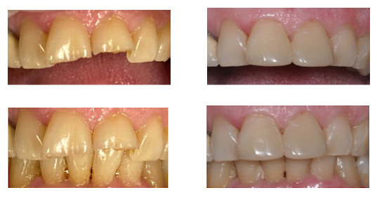 carillas-composite-cllinica-ferreiro